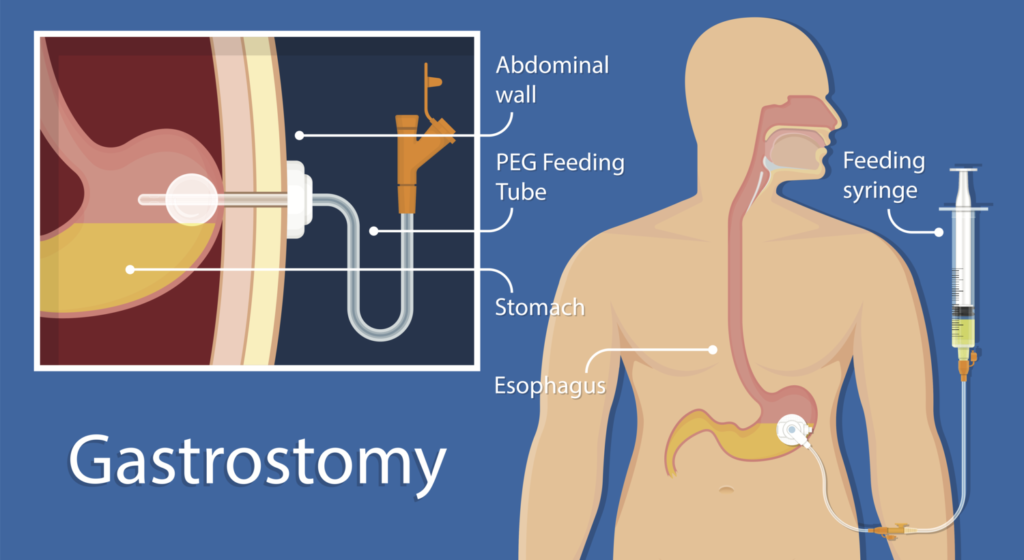 DNE.111 Gastrostomy feeding – Nurses Online Discussion