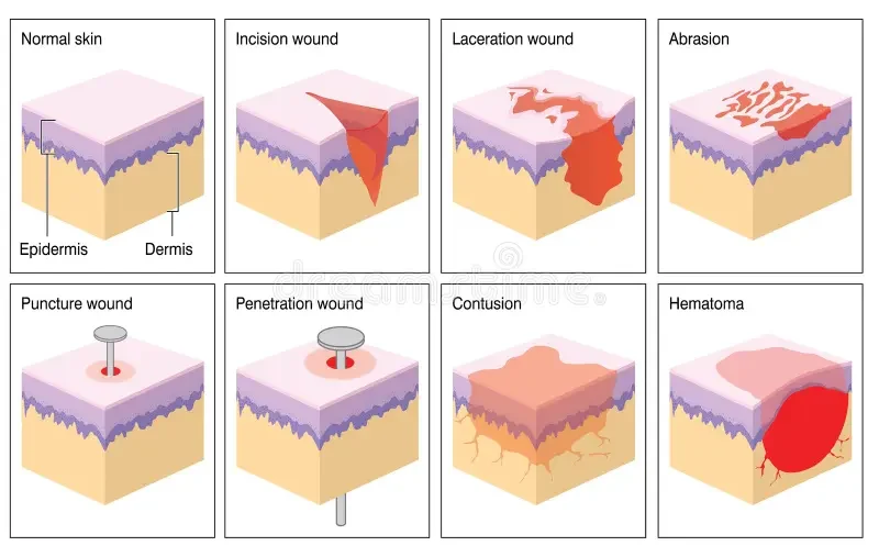 skin-wound illustrations-Nurses online discussion