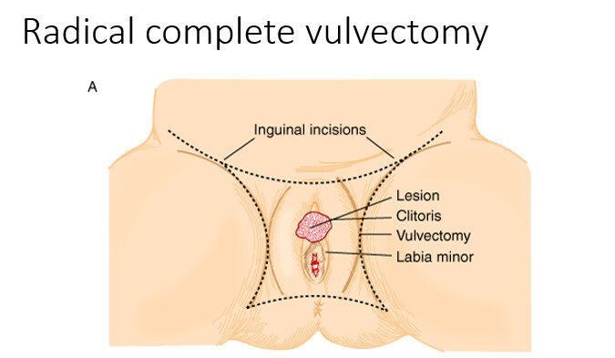 Radical-complete-vulvectomy