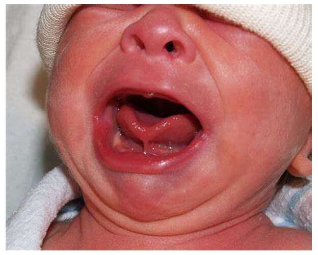 Ankyloglossia (Tongue Tie)