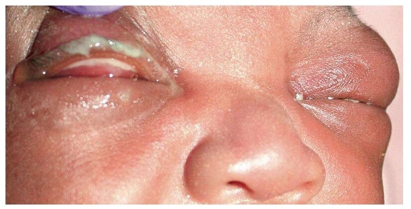 Ophthalmia neonatorum