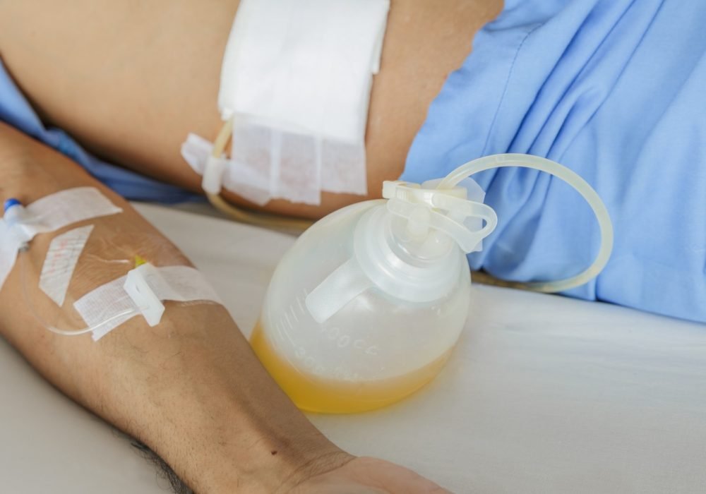 Indications-of-Drains-nursesonlinediscussion